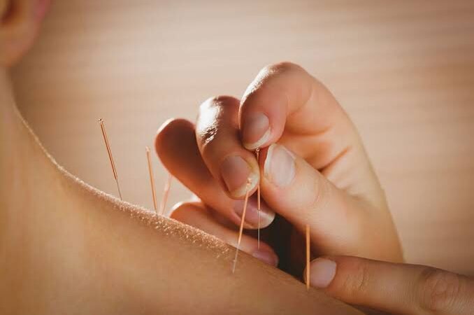 benefits of acupuncture